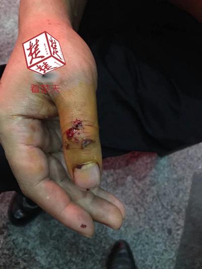 民警大拇指被咬