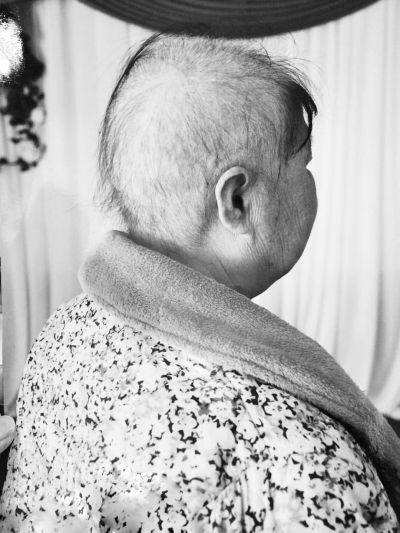     化疗之后张兰大面积掉发