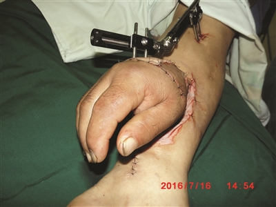 右手“寄养”在左腿上，徐州仁慈医院完成了一台高难度手术。