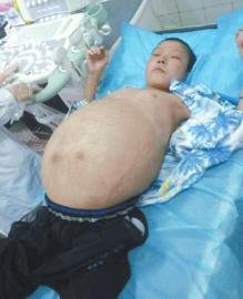 挺了9年“大肚子” 20岁小伙想“瘦身”（图）