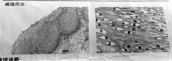 2016年11月24日第二张病理报告