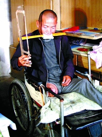 河北男子自锯病腿续：骨头跟冰碴子一样碎掉