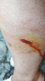 郭女士腿上被猴子咬的伤口。