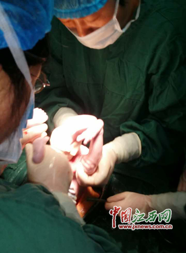 卢某安全诞下连体男婴