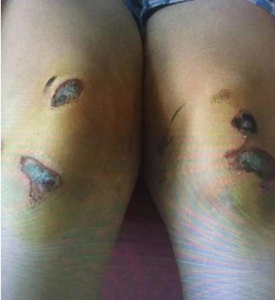 胳膊红肿不堪、双膝惨不忍睹、手上还有伤疤，这一个小姑娘咋能伤成这样？