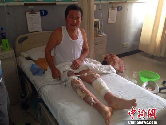 王占宾坐在医院的病床上，他刚刚做完植皮手术，腿上插满管子。　王天译　摄