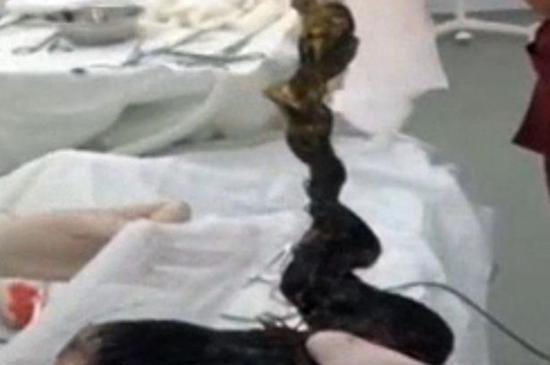 哈萨克斯坦女孩胃中竟藏逾2斤重头发