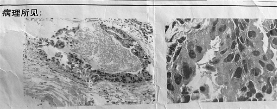 2016年11月10日第一张病理报告